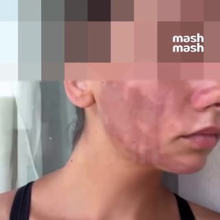 Жительница Краснодара получила ожоги после фототерапии