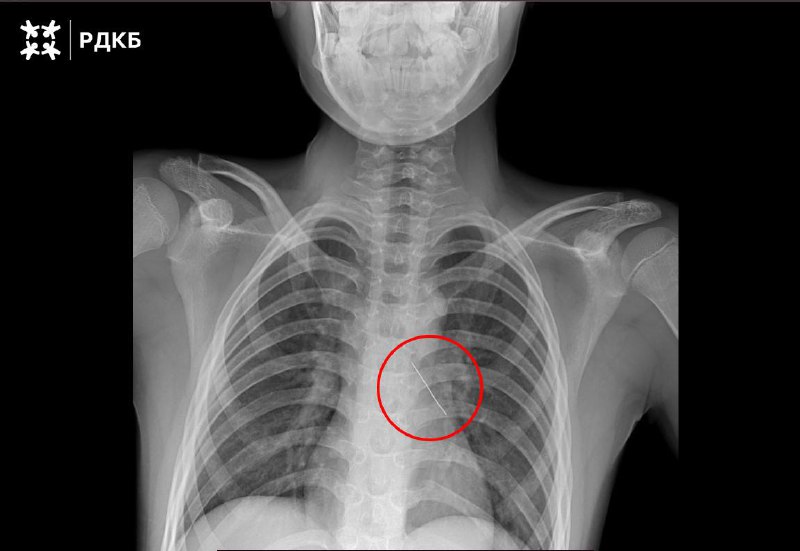 Московские хирурги спасли ребенка, вдохнувшего булавку