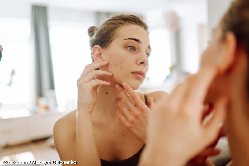 Почему прыщи не проходят у взрослых