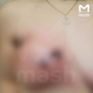 Врачи забыли салфетку в груди пациентки