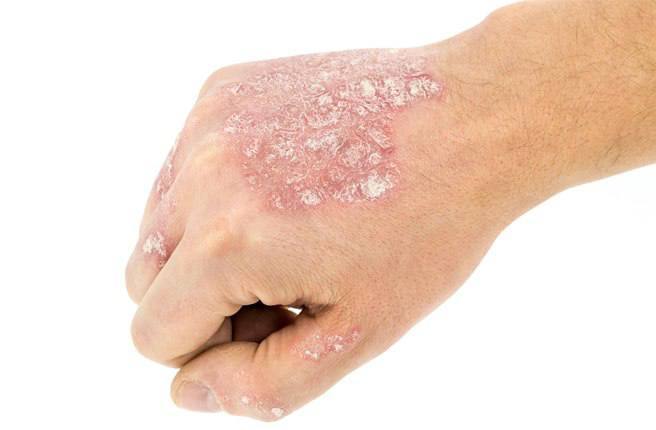 Псориатический артрит: этиология, диагностика и лечение