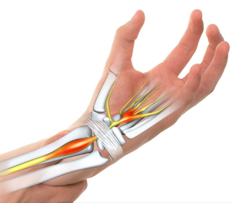 Туннельный синдром запястья: причины, симптомы и лечение