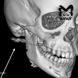 Школьник ранен в лицо пневматической винтовкой в Приморье