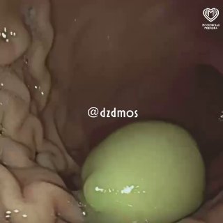 Ребенок проглотил оливку, потребовалась операция