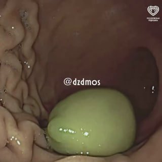 Врачи спасли ребенка, у которого в желудке застряла оливка