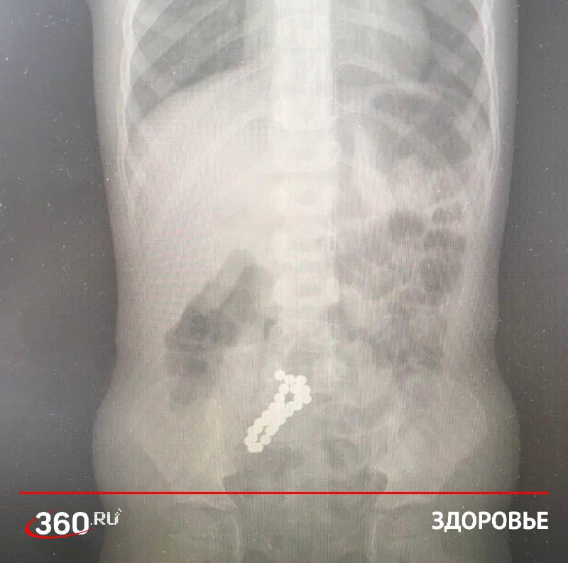 Из кишечника ребенка извлекли 30 магнитов