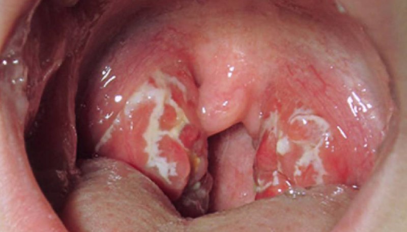 Ангина: симптомы, причины и лечение