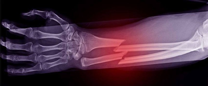 Процесс сращения переломов и особенности лечения в зоне боевых действий