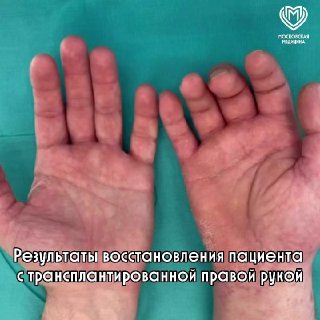 В России впервые запустили программу пересадки кистей рук