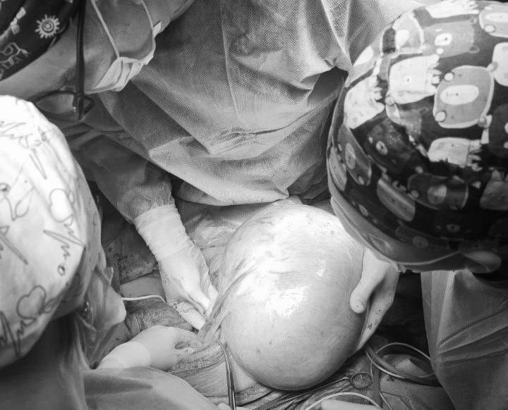 Врачи удалили две гигантские опухоли размером с дыню у жительницы Подмосковья