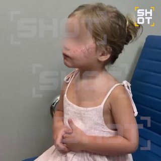 Девочка заразилась импетиго на Бали после купания в бассейне