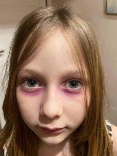 Девочка из Томска симулировала редкую болезнь фломастерами, чтобы не ходить в школу