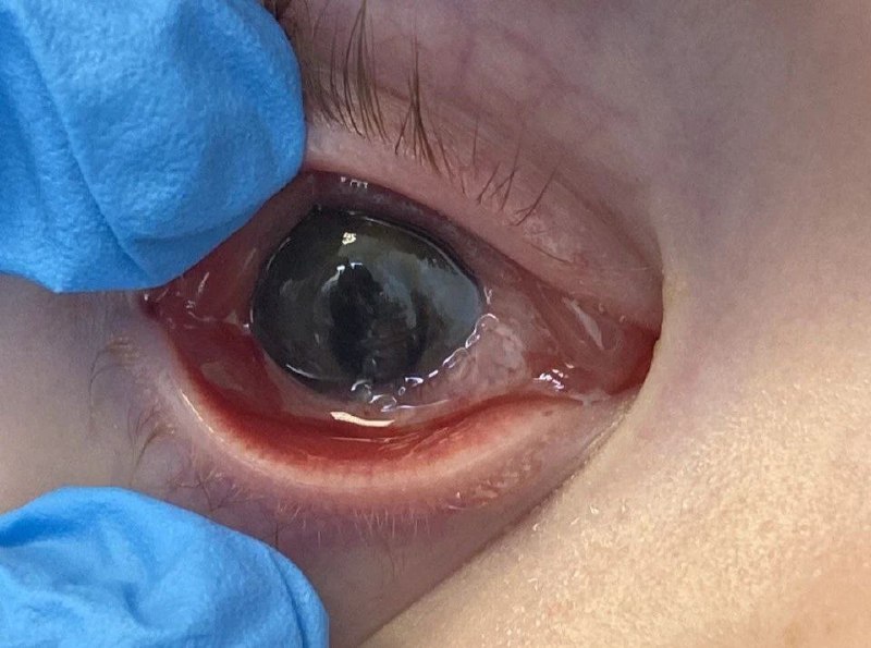 Врачи спасли зрение ребенку, поранившему глаз ножом во Владивостоке