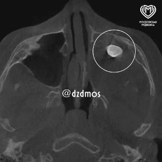 В Москве удалили зуб из носа подростка