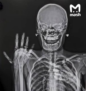 Рентген с кольцом: новый свадебный тренд среди медиков