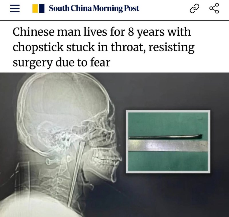 Мужчина 8 лет жил с палочкой для еды в горле