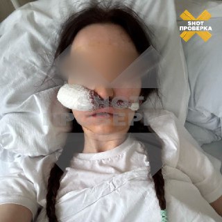 Инородное тело в носу после удаления зуба привело к угрозе слепоты и абсцесса мозга