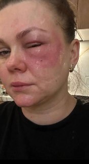 Уколы со спермой лосося для омоложения: риски и осложнения