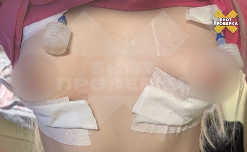 У москвички загноилась грудь после установки имплантов: операция привела к некрозу и удалению