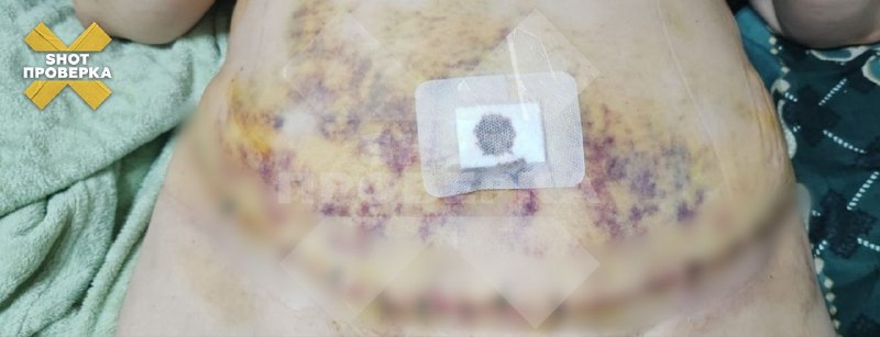 Растёт число пострадавших от действий пластического хирурга Николенко: пациентки жалуются на тяжёлые осложнения