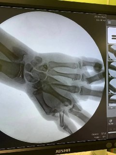 Врачи собрали кисть ребенка после взрыва снаряда в Калининграде