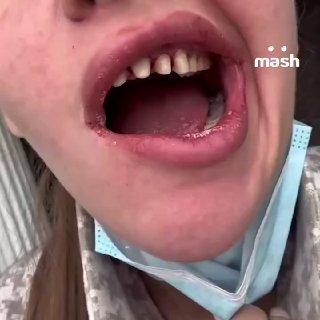 Блогерка осталась без зубов после установки виниров: врачи забыли инструменты в корнях
