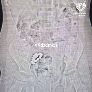 Ребенка, проглотившего 19 магнитов, спасли в Москве