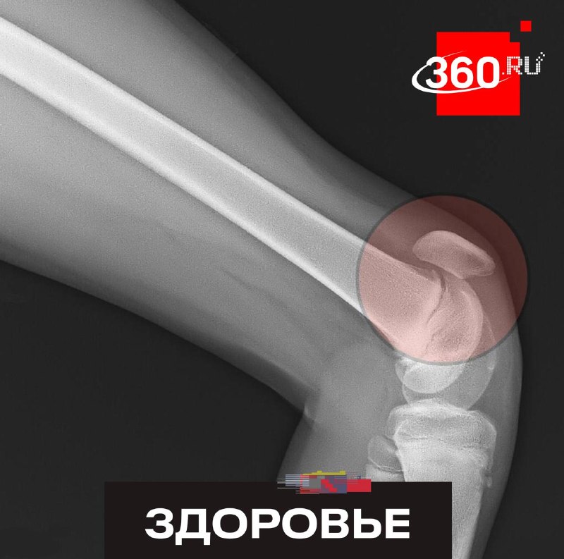 Врачи спасли руку и колено юной волейболистки после неудачного падения