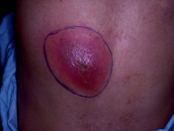 Как лечить уплотнение после укола: советы инструктора тактической медицины