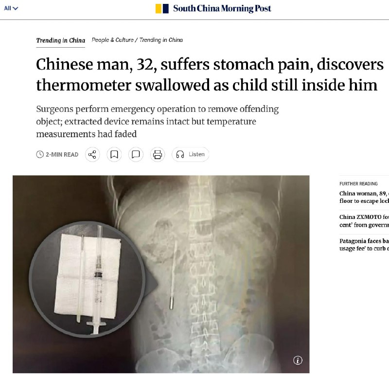 Житель Китая 20 лет прожил с термометром в животе