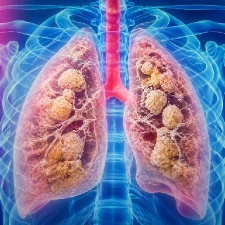 Рост заболеваемости «попкорновой болезнью» среди вейперов в России