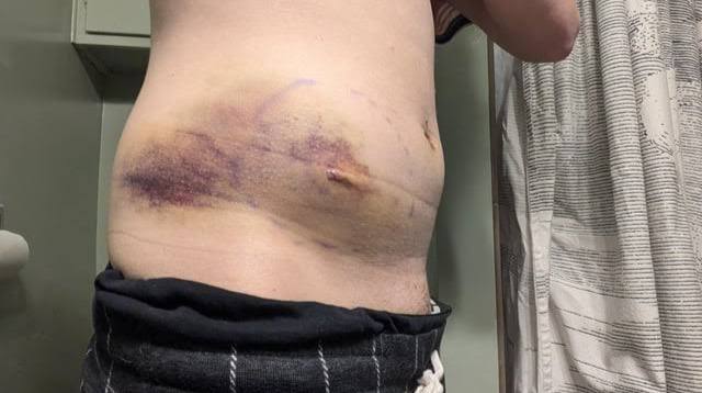 Признаки и алгоритм действий при внутреннем кровотечении в зоне СВО