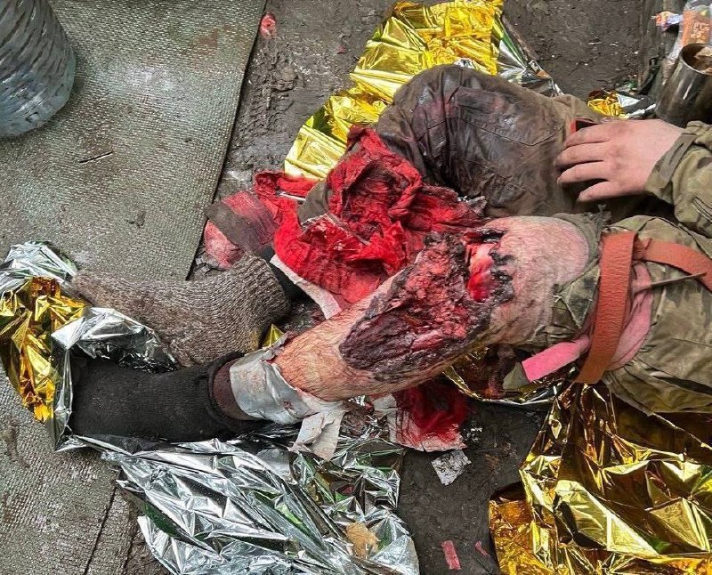 Протоколы выживания: как предотвратить сепсис при ранениях в полевых условиях