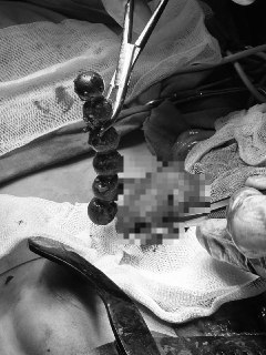 Подмосковные хирурги удалили почти килограмм магнитов из кишечника ребенка