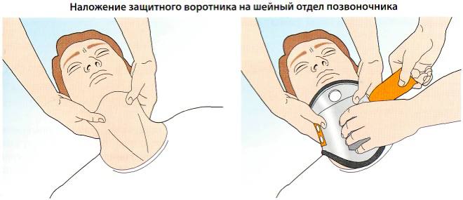 Фатальность переломов шейного отдела позвоночника: причины и статистика боевых потерь