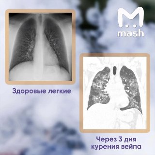 Вейпинг привел к необратимому повреждению легких у молодого человека