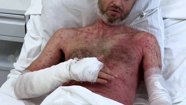 Приоритеты оказания помощи при сочетании острой кровопотери и ожогового шока в полевых условиях
