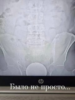 В Москве медики извлекли стеклянный шар из заднего прохода москвича