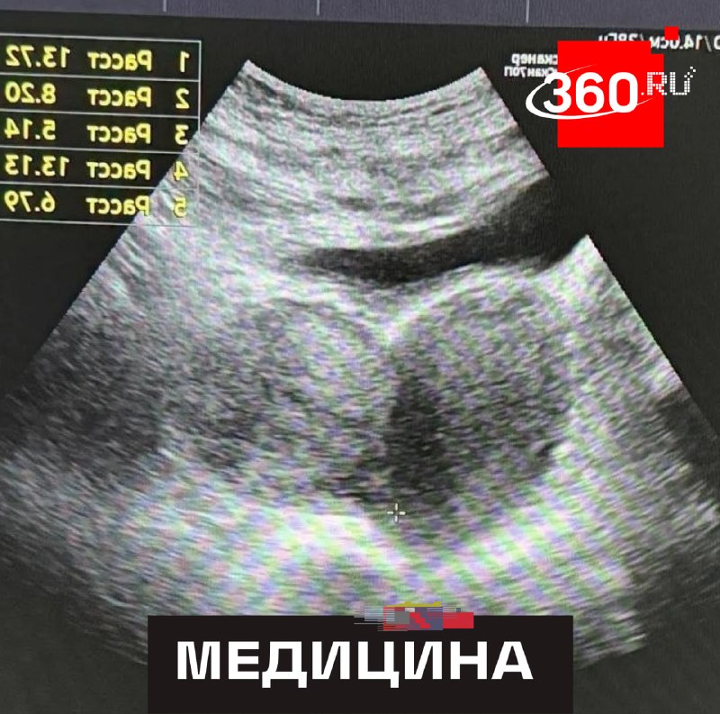 Подмосковные врачи помогли родить пациентке с двумя матками