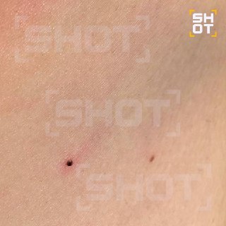 Наноклещи объявились в России — микрокровопийцы атакуют людей и могут быть опаснее взрослых особей