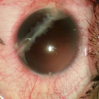 Травматическая катаракта в зоне СВО: диагностика и первая помощь