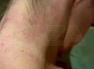 Россиянка получила отек Квинке после посещения фастфуда на Бали