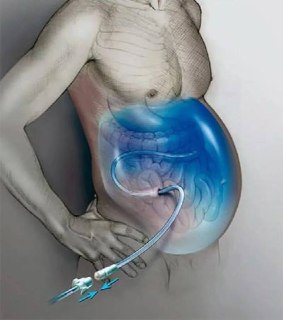 Асцит у военнослужащих в зоне СВО: причины, диагностика и лечение