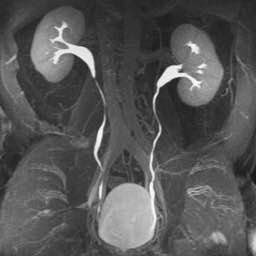 Жизнь после потери почки: как меняется уровень жизни