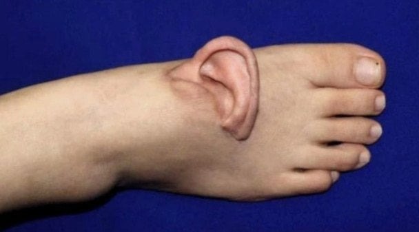 Китаянка пять месяцев ходила с ухом на стопе после страшной травмы