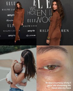 Хейли Бибер объяснила причину синяка под глазом