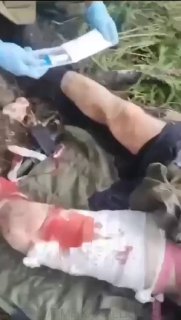 Внутрикостная инфузия: руководство по тактической медицине